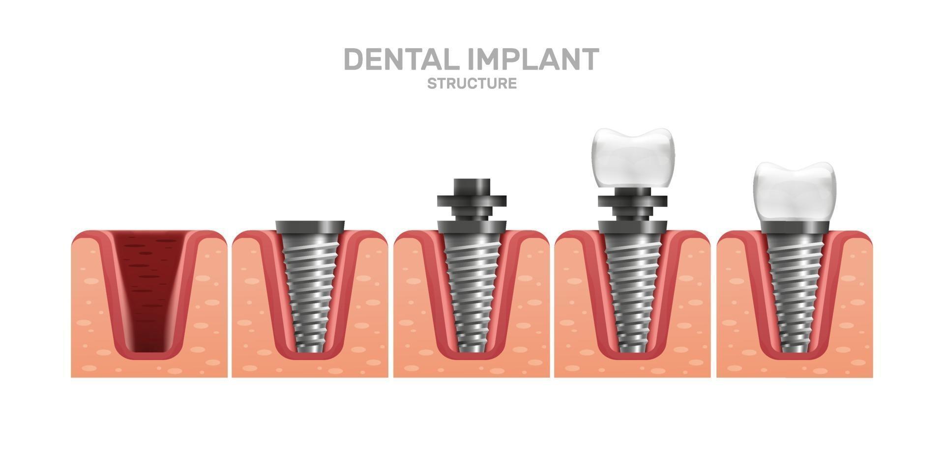 tandheelkundige implantaatstructuur en volledige plaatsingsstappen in realistische stijl. aanslag, schroef. gingiva. vector