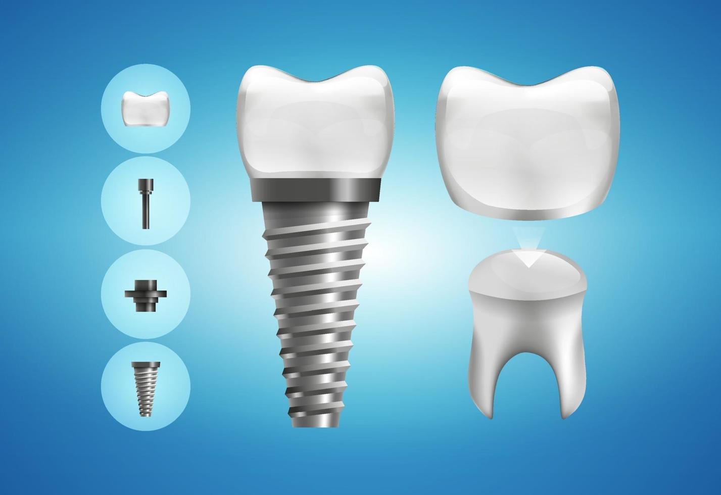 tandheelkundige implantaatstructuur en kroonrestauratie in realistische stijl. medisch correct. vector illustratie