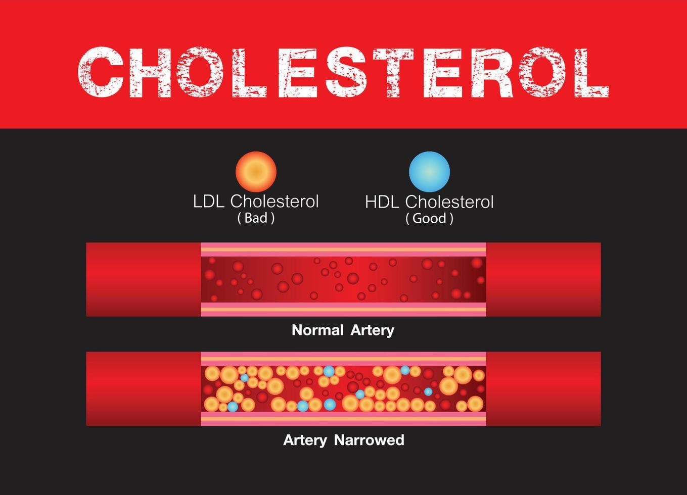 cholesterol in slagader, Gezondheid risico , accumulatie bloed, zwaarlijvigheid, vector ontwerp