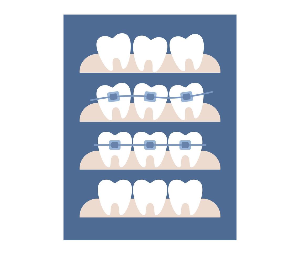 tandheelkundig een beugel icoon. orthodontisch behandeling en kunstmatig tandheelkunde. voordat na rechttrekken tanden. vector vlak illustratie