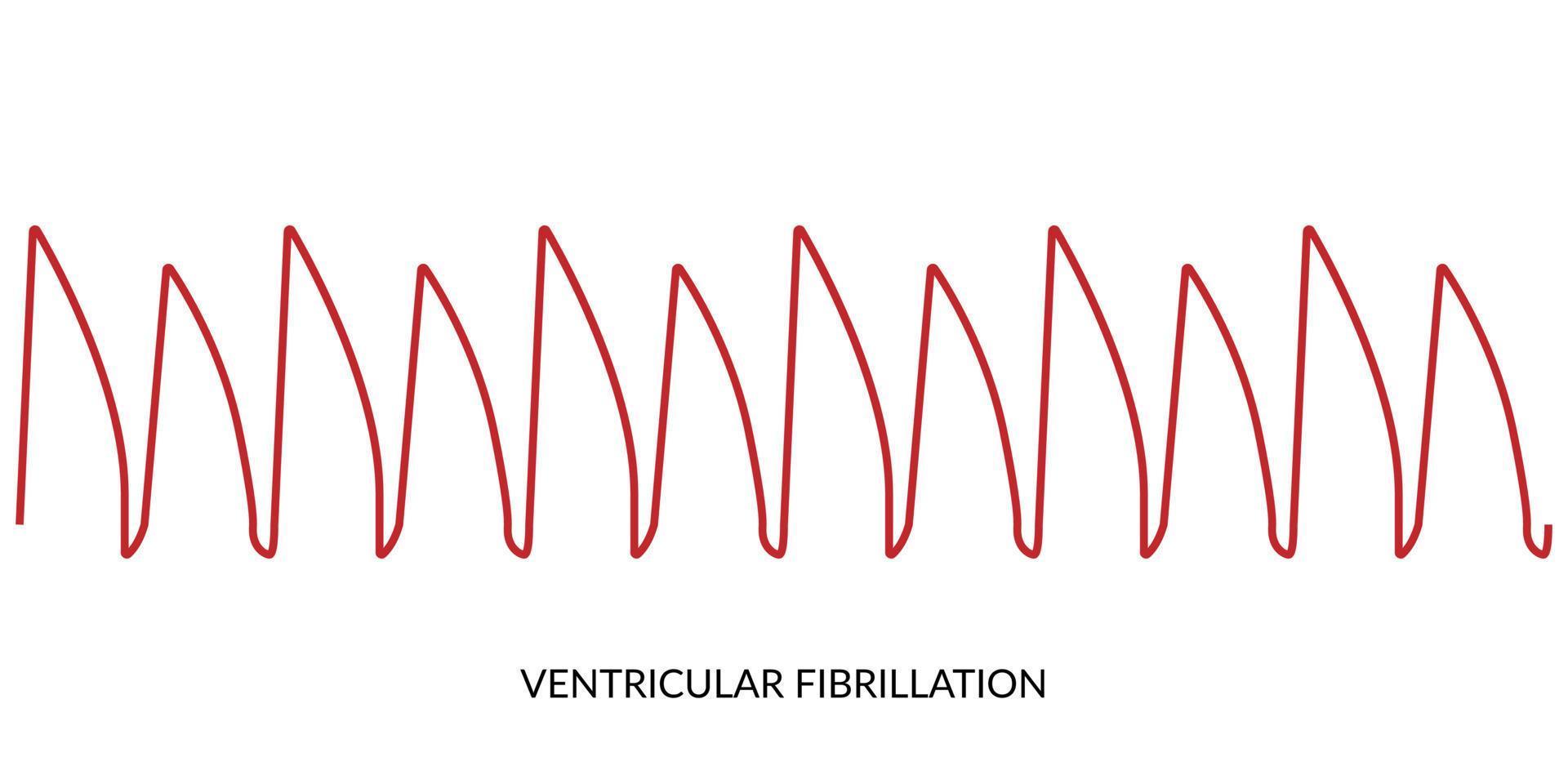 ecg hartslag lijn. elektrocardiogram vector illustratie. ventriculaire fibrillatie