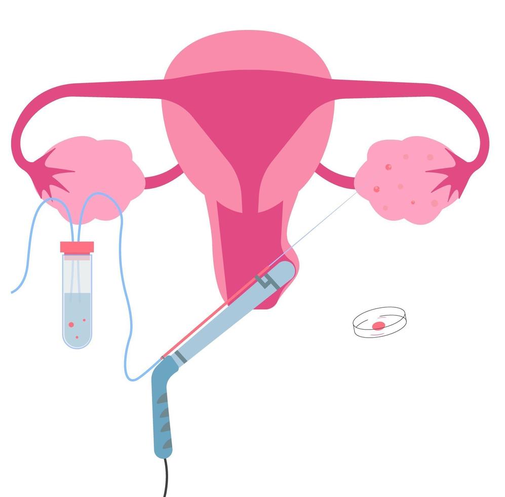 transvaginale oöcytherstel, een van in-vitrofertilisatie of ivf-procedure. vector