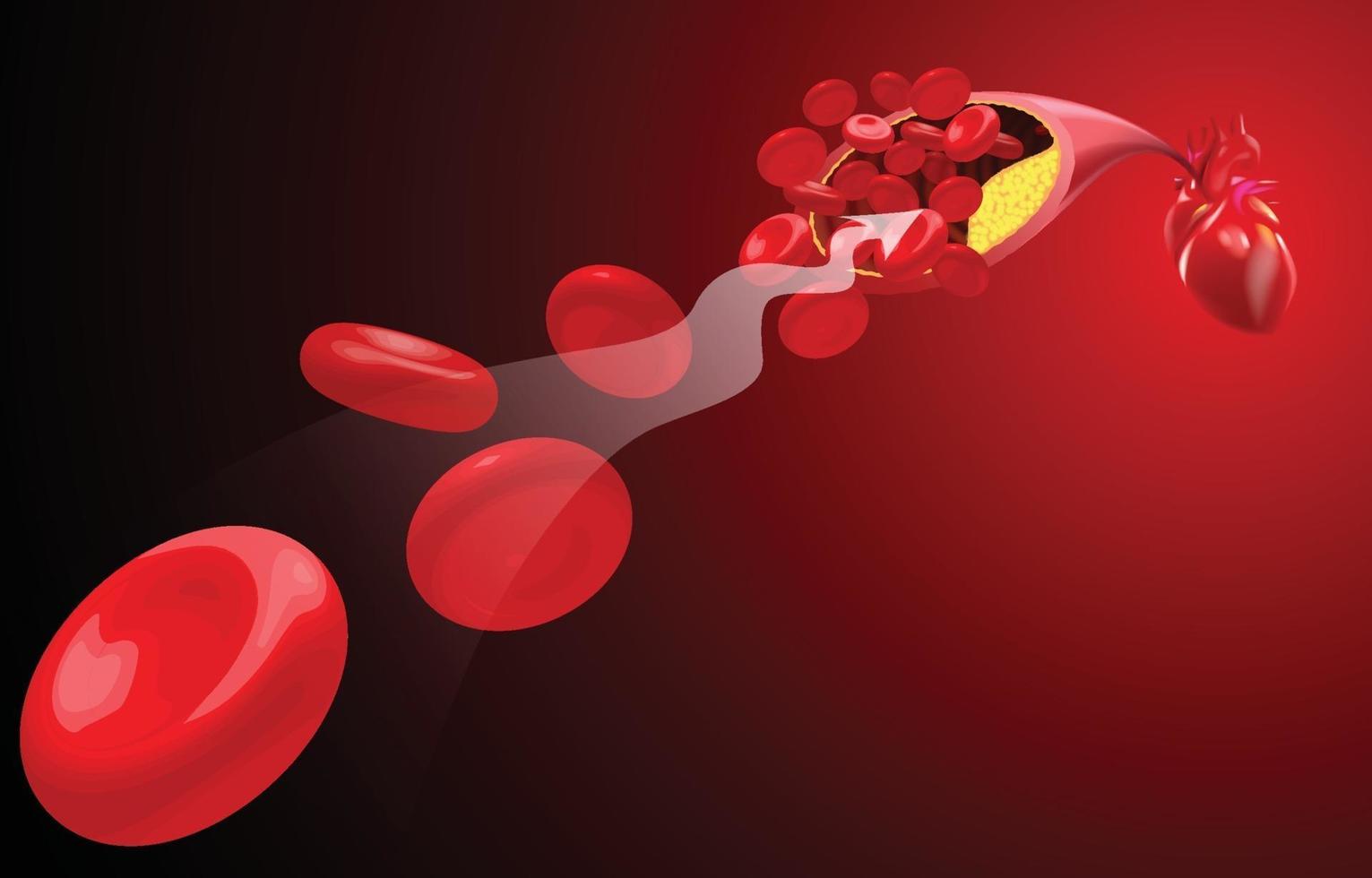 de stroom van rode bloedcellen wordt geblokkeerd door atheroma. vector
