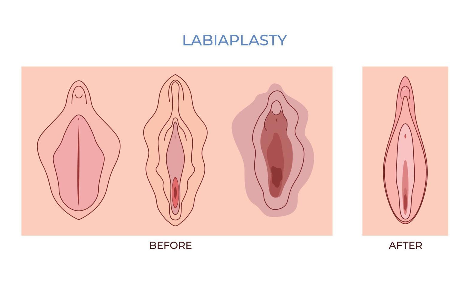 labiaplastie. vaginoplastie. Dames genitaal van minor vulval schaamlippen los lippen schoonheid chirurgie naar vastdraaien vector