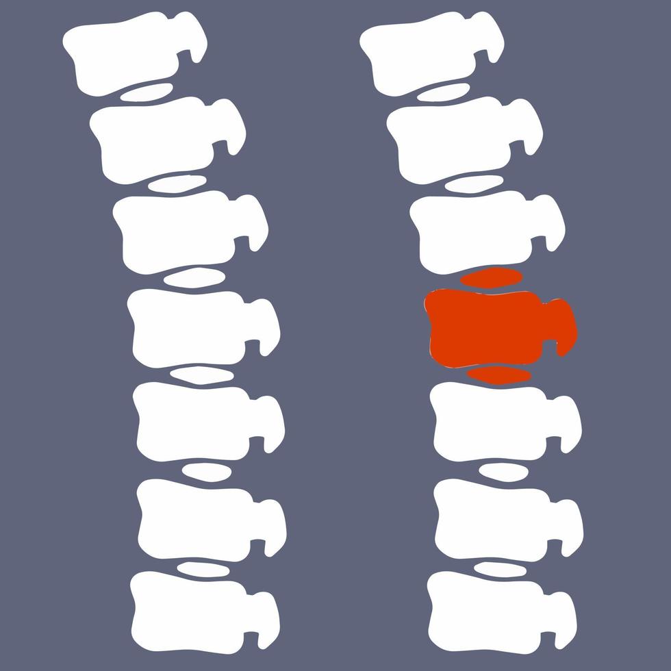 problemen met ruggengraat. houding problemen. ziek rood plaats. barst in wit bot. vergroten glas. logo in cirkel. wervel kolom. röntgenstraal van intern organen. medisch zorg. breuk van tussenwervel schijven vector