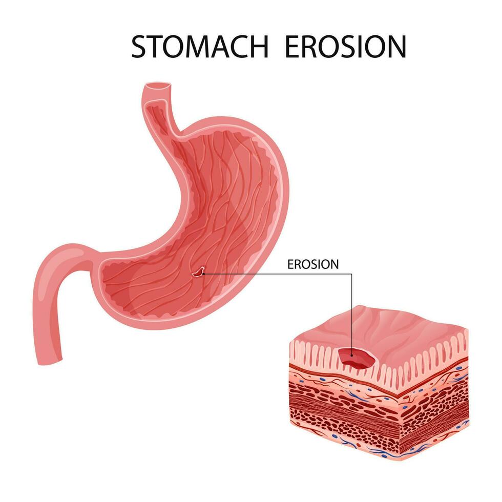 menselijk maag erosie vector illustratie