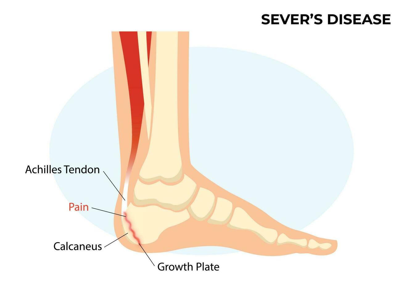 scheiden ziekte, hielbeen apofysitis. enkel letsel gebroken bot vector