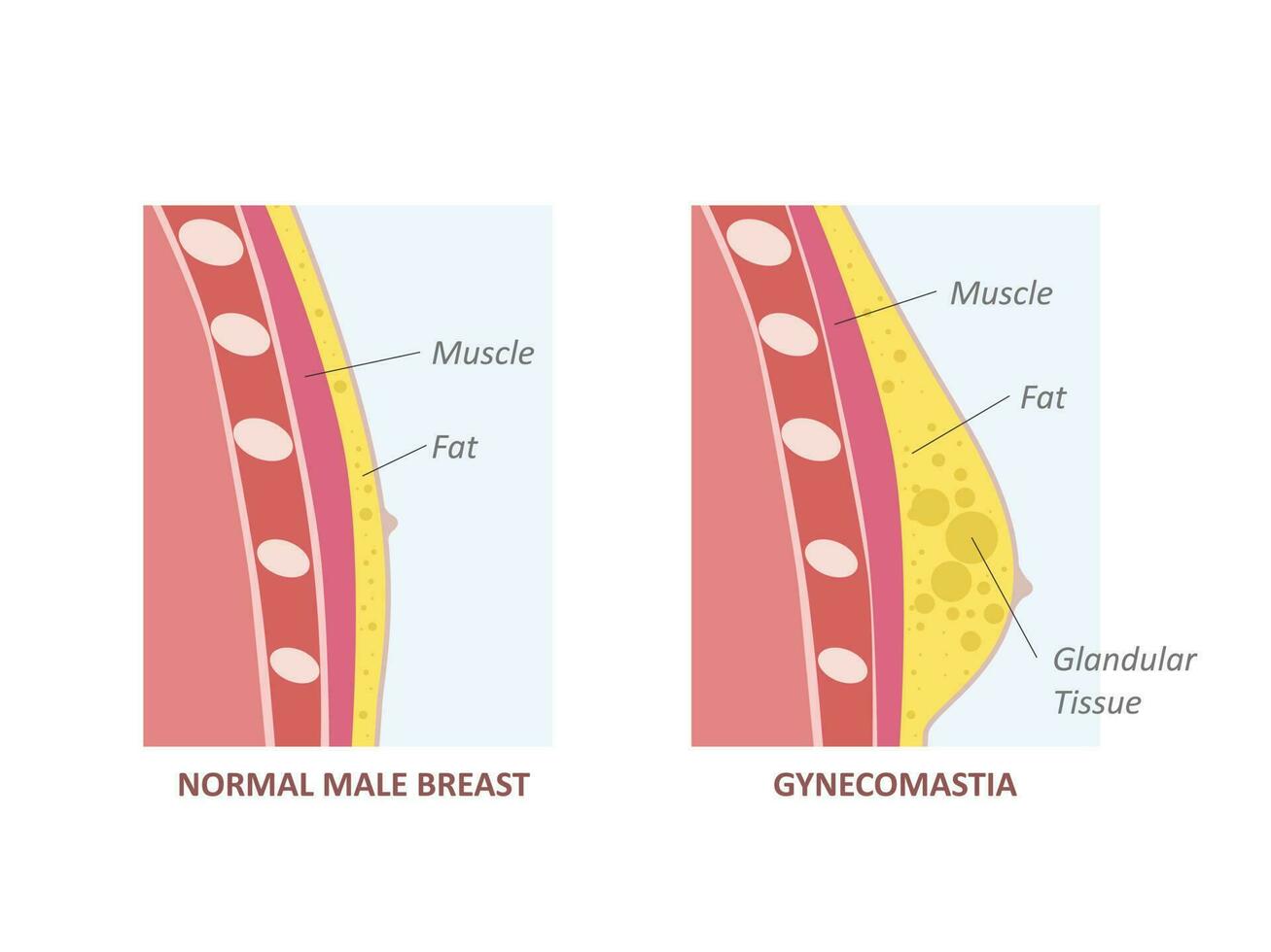 hormoon onbalans tussen oestrogenen en androgenen. gynaecomastie vector