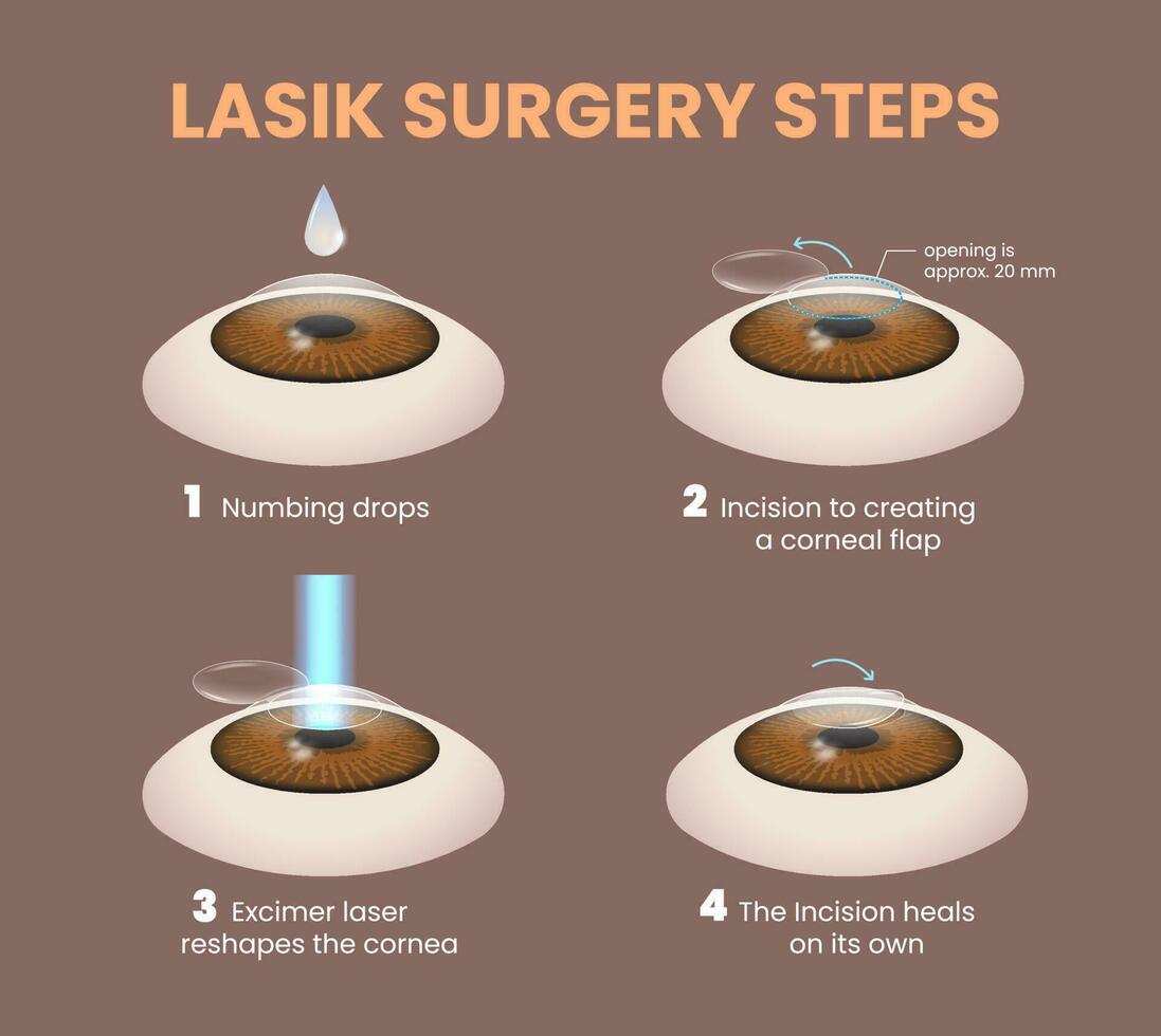 illustratie van lasik oog chirurgie stappen vector