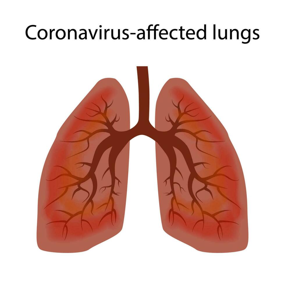 menselijk longen beschadigd door coronavirus covid19. de concept van de stadium van schade naar de ademhalings kanaal virus. geïsoleerd vector eps10.