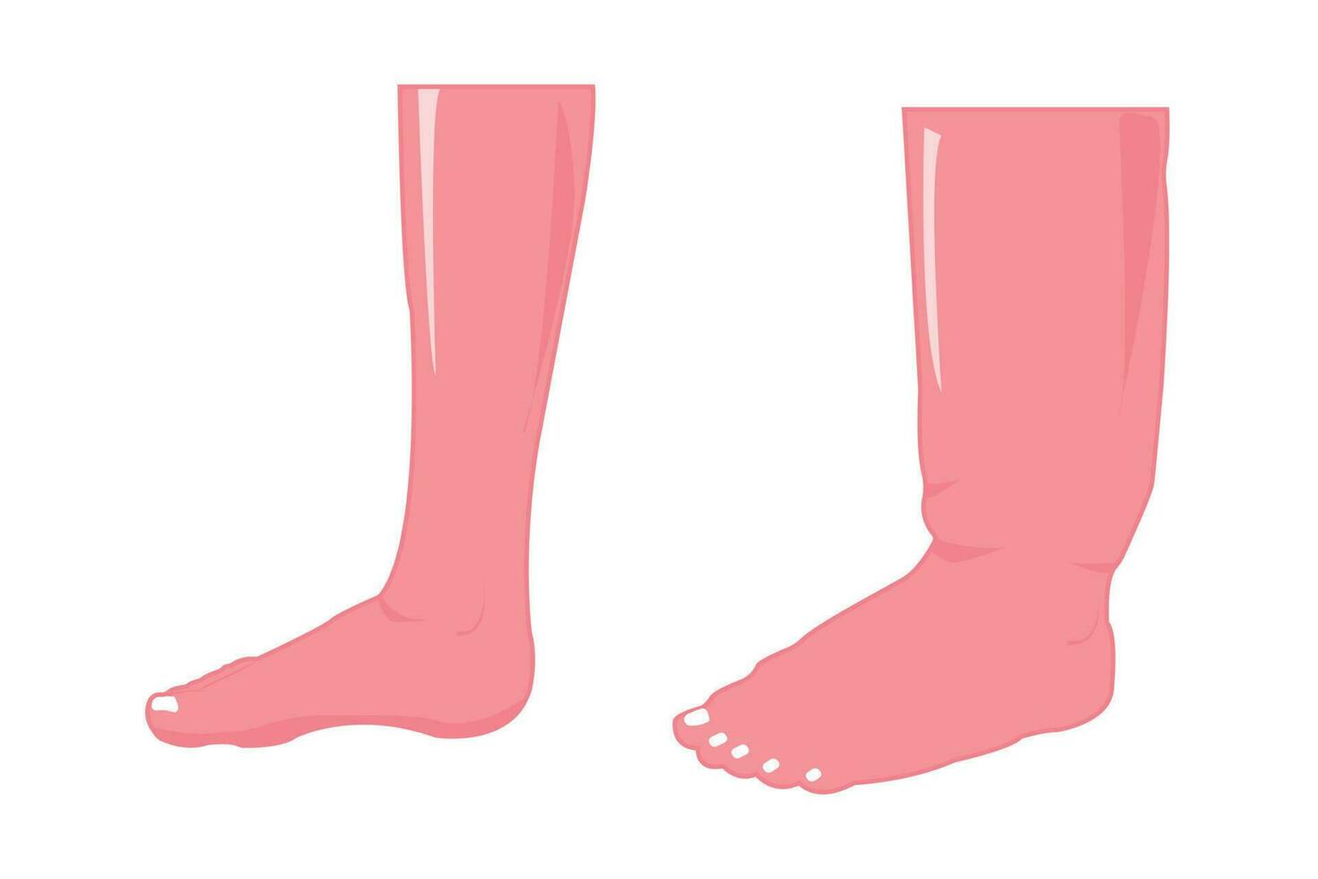 normaal en abnormaal voet. oedeem voet illustratie voor onderwijs. eps 10 vector