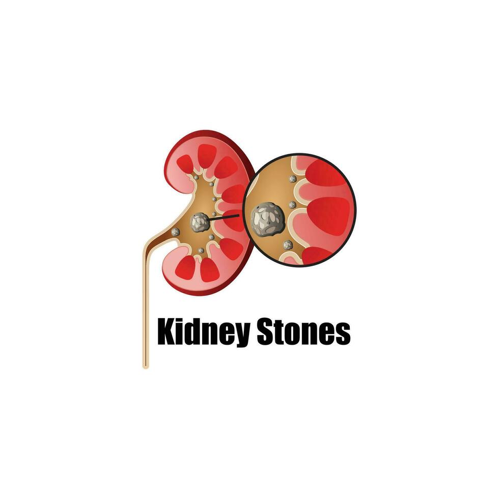 menselijk nier stenen, nier binnen, nier systeem, Boon vorm geven aan, vector illustratie.