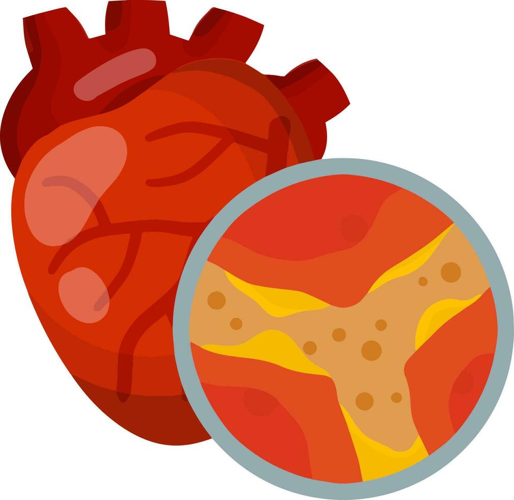 cholesterol in ader en slagaders. hart en orgaan ziekte. verstopping en obstructie van kanaal. uitvergroot visie onder microscoop. Gezondheid probleem. vlak medisch onderwijs vector