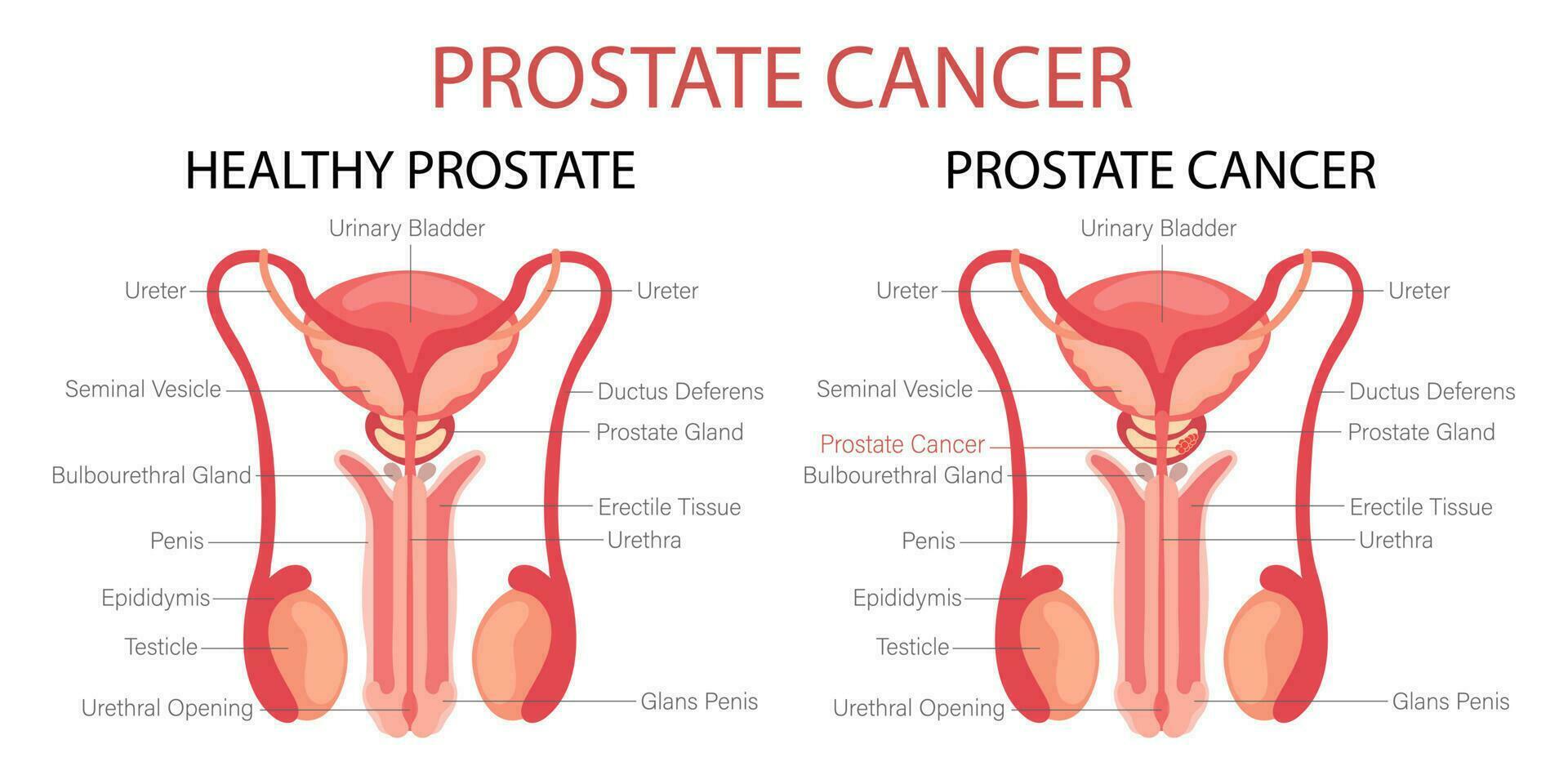 prostaat kanker. mannetje voortplantings- systeem. anatomie van de intern organen van Mens. infographic banier, grafiek, vector