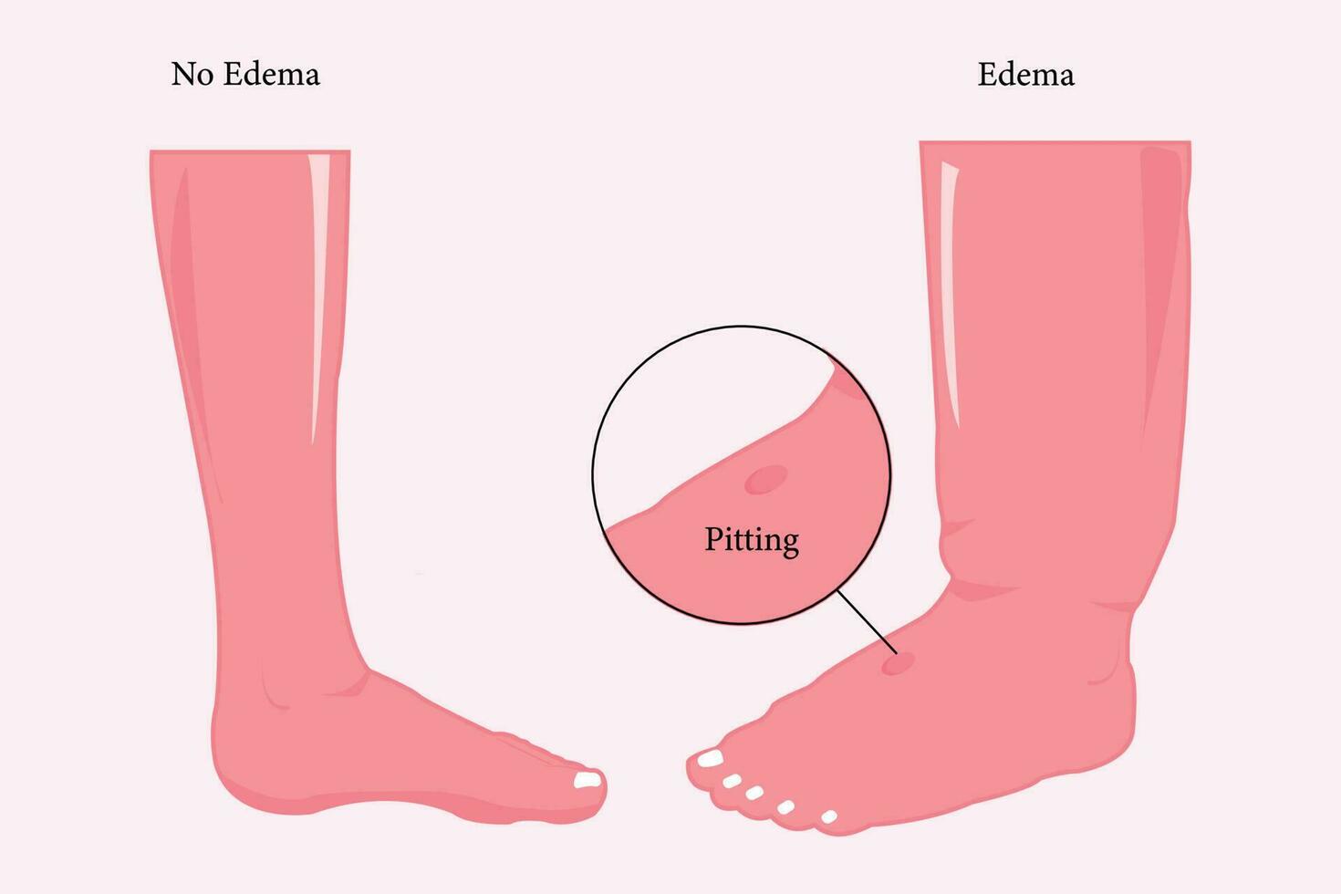 vergelijking van normaal voet en oedeem voet, vlak illustratie voor onderwijs. eps 10 vector