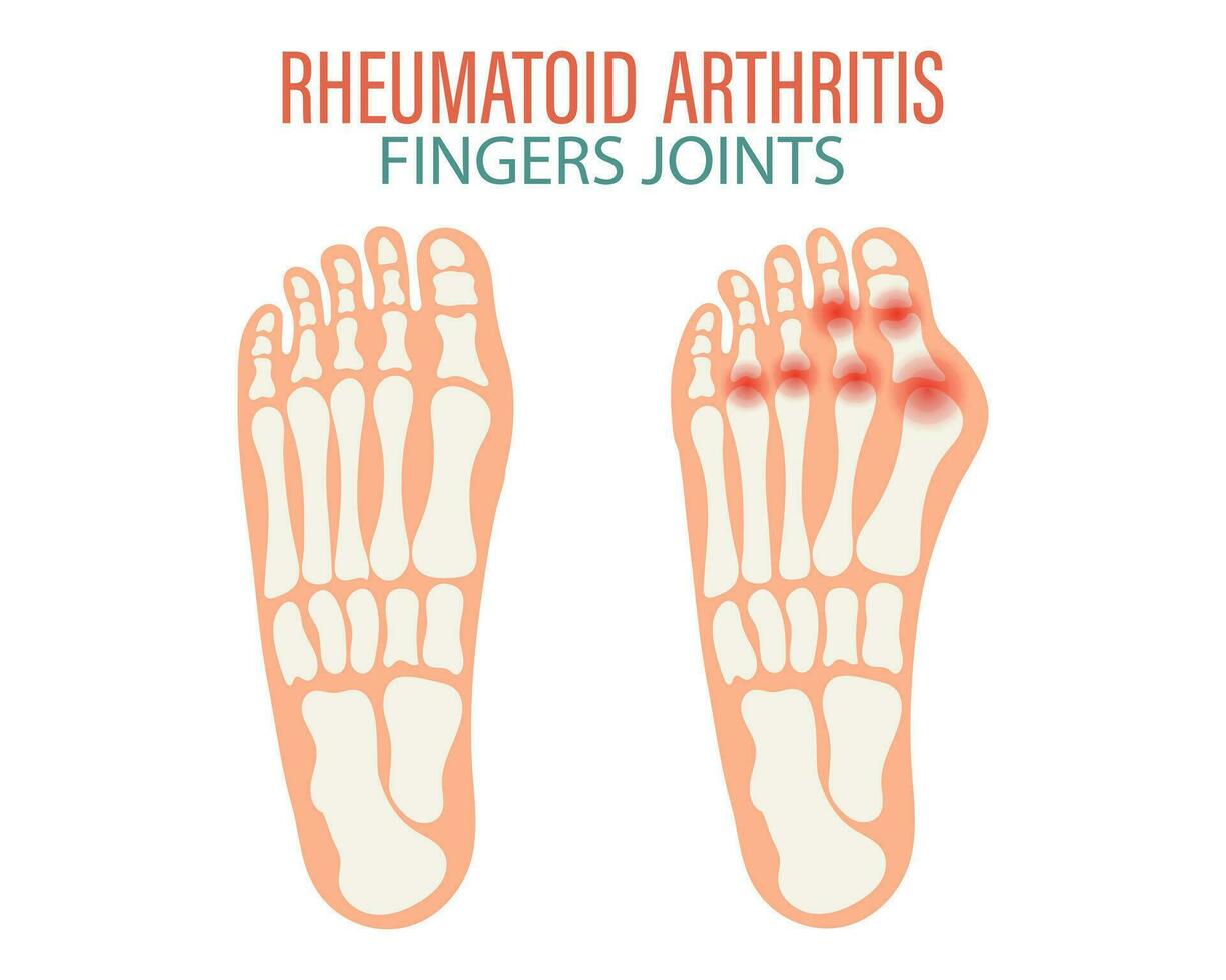 reumatoïde artritis. artrose van de gewrichten van de vingers en tenen. medisch concept. infographic poster, banier, vector