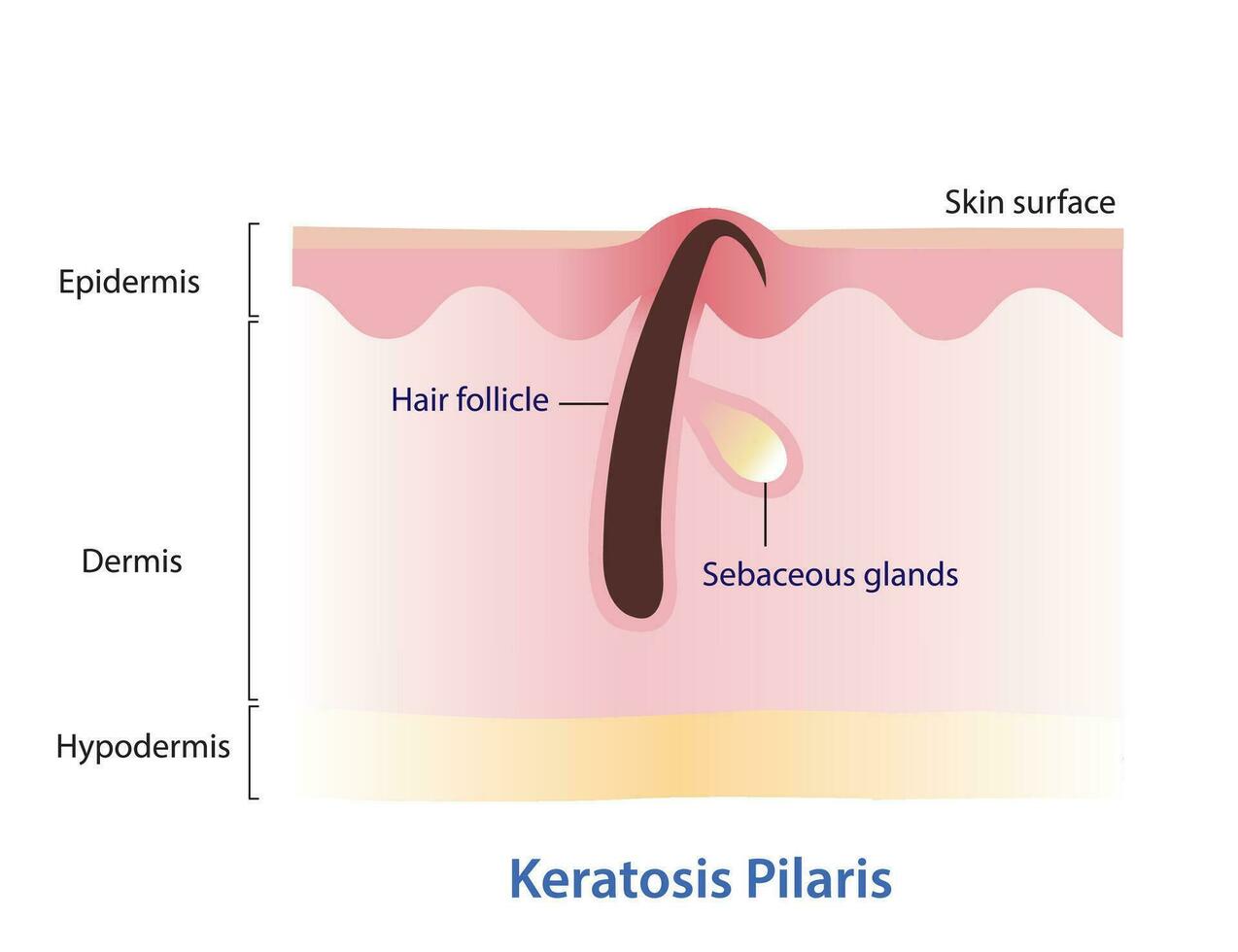 keratose pilaris. ingegroeide haar, kip huid vector illustratie geïsoleerd Aan wit achtergrond. haar- heeft gegroeid terug in de huid oppervlak. hobbelig huid dat looks Leuk vinden klein speldenprikken of kippenvel