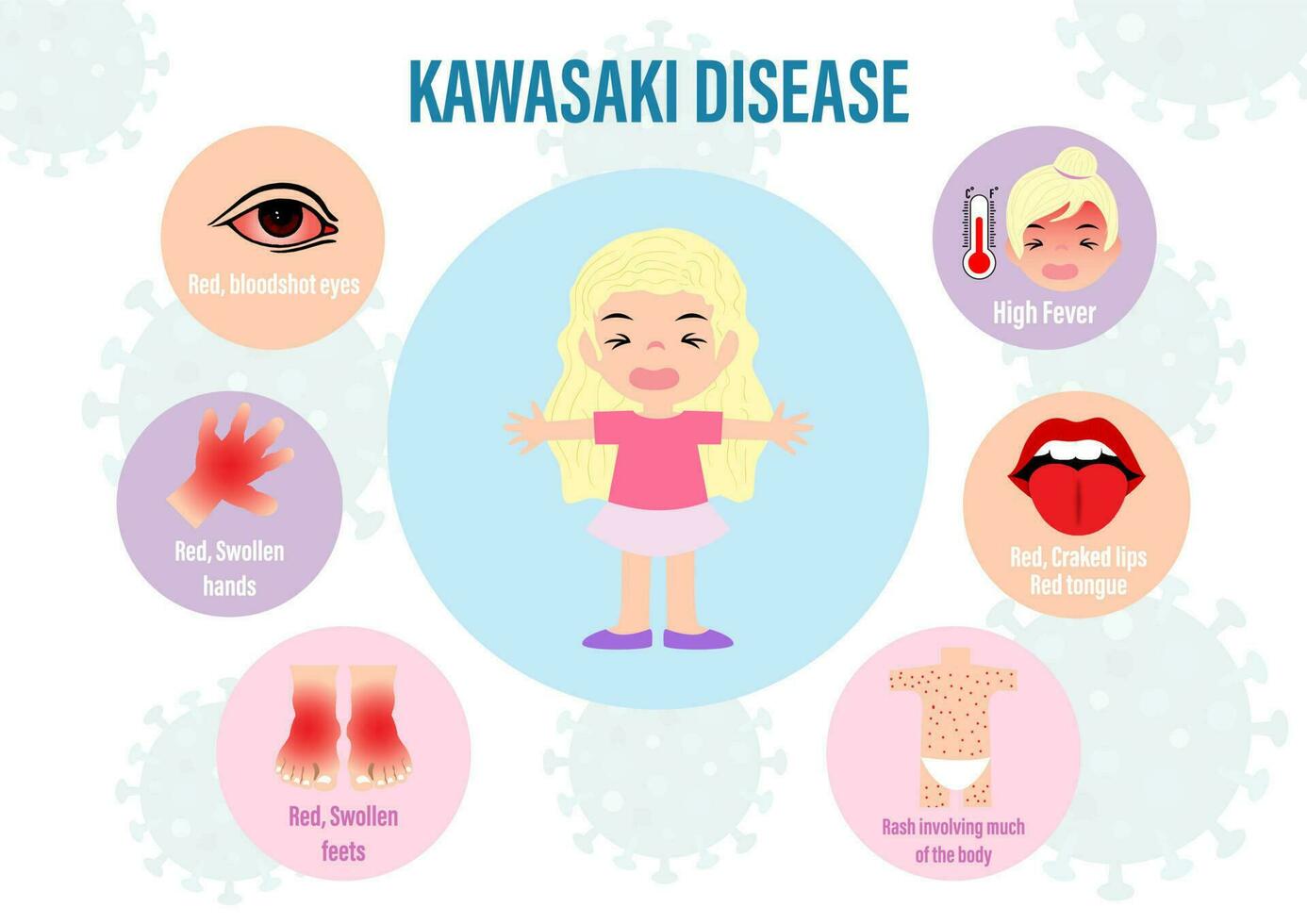 afbeelding info grafisch van kawasaki ziekte in kind met tekenfilm karakter en belettering Aan virus symbolen en wit achtergrond. medische poster van de kawasaki ziekte in vector ontwerp.
