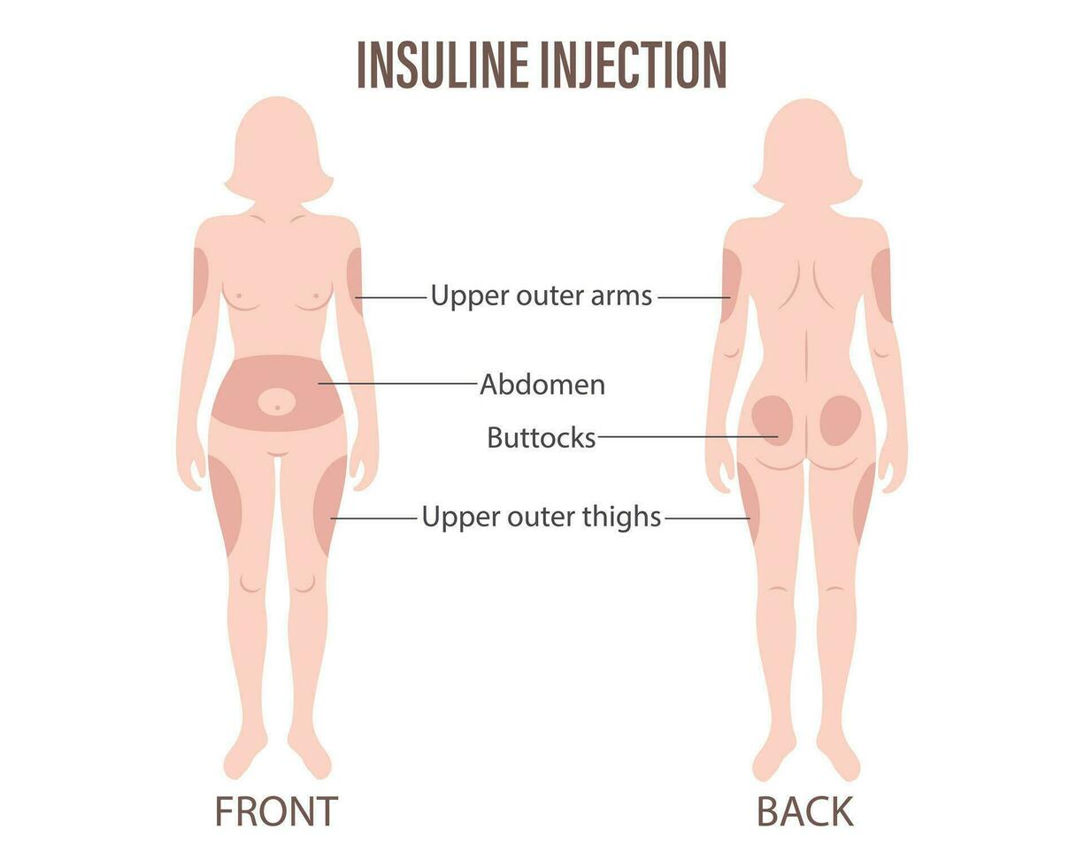 suikerziekte. insuline injectie sites Aan de menselijk lichaam, bovenste armen, buikspier, zitvlak, bovenste dijen. medisch infographic banier, poster vector