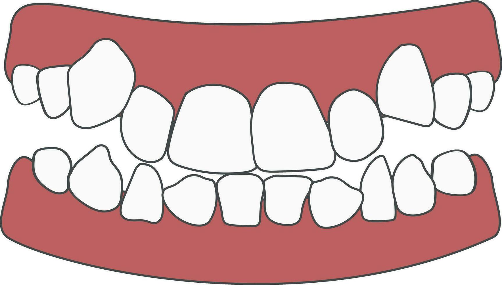 orthodontisch probleem tanden drukte. abnormaal uitbarsting. tegenover occlusie, Open beet, druk tanden, gaatjes, gebit. vector illustratie geïsoleerd