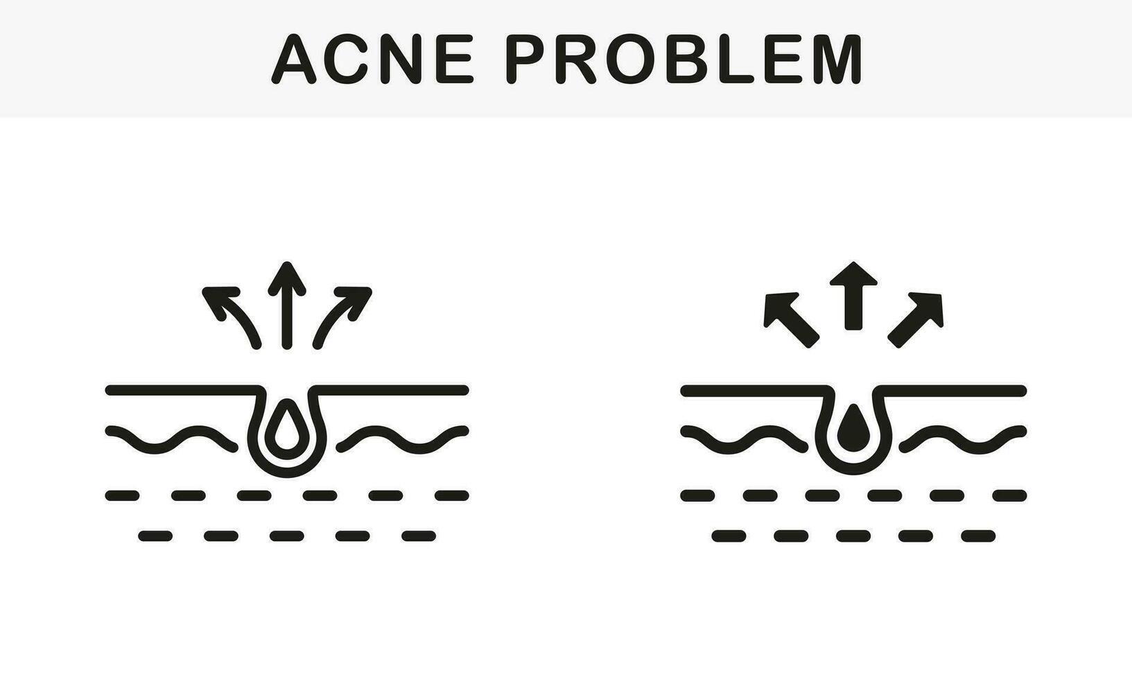 huid acne, puistje, comedo pictogram. mee-eter en ontsteking talg lijn en silhouet zwart icoon set. vuil huid probleem symbool verzameling. geïsoleerd vector illustratie.