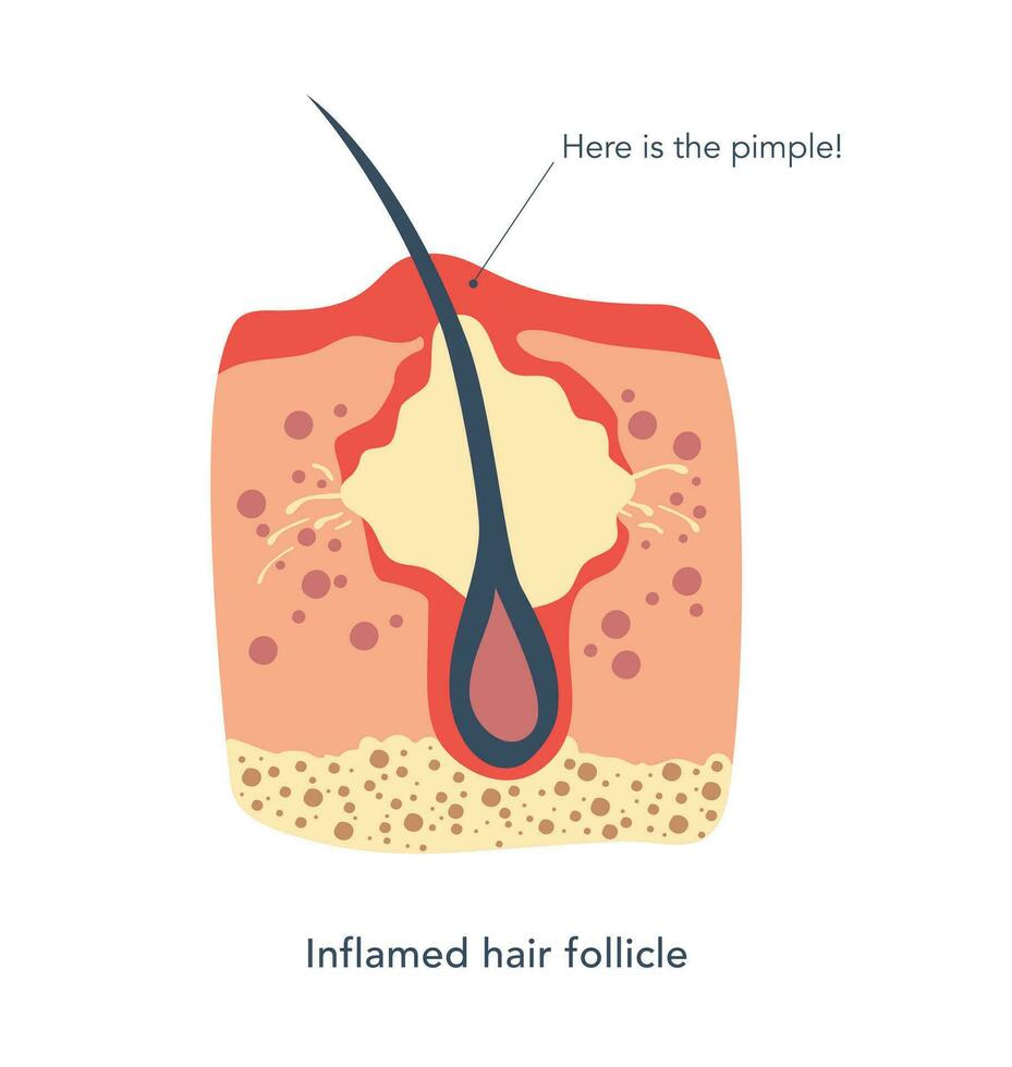 ontstoken follikel medisch schema's onder microscoop. ingegroeide haar- Leidt naar de roodheid en ontsteking, dat geassocieerd met puistjes. aangesloten haar- follikel met olie, dood huid. vector illustratie