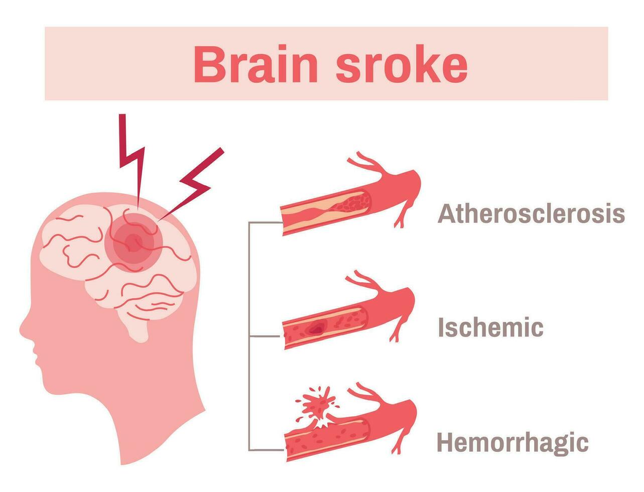 beroerte vlak infographics vector