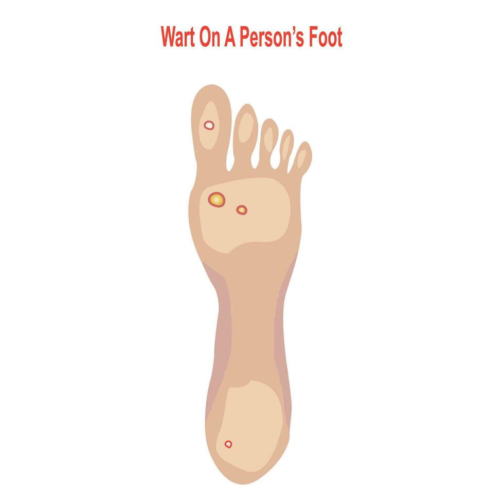 wrat Aan een personen voet, moeilijk, korrelig groei Aan hakken of ballen van voet, plantaris wrat vector