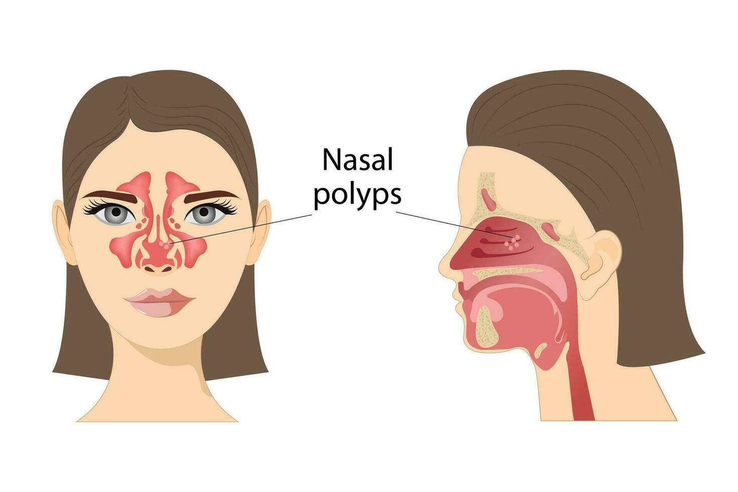 medisch vector illustratie van nasaal poliepen. niet-kankerachtig neoplasmata Aan de nasaal slijmvlies of sinussen Aan een wit achtergrond