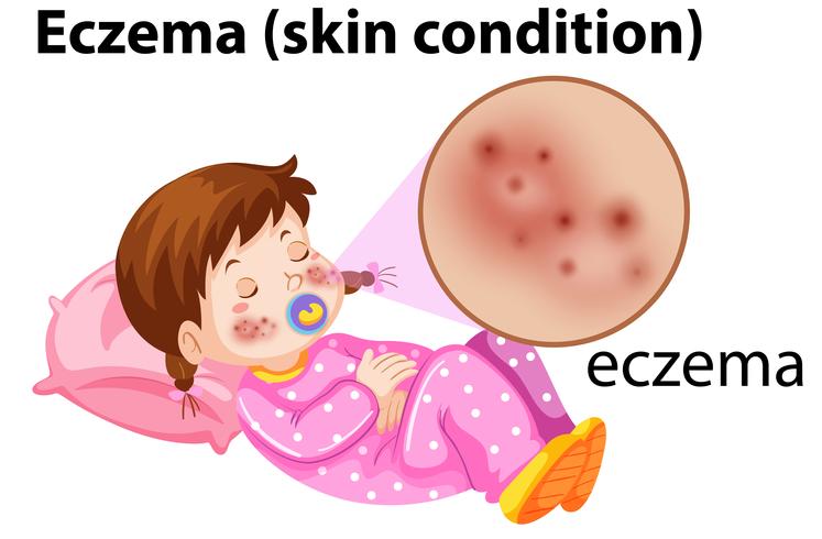 Magnefied eczema op jong meisje vector