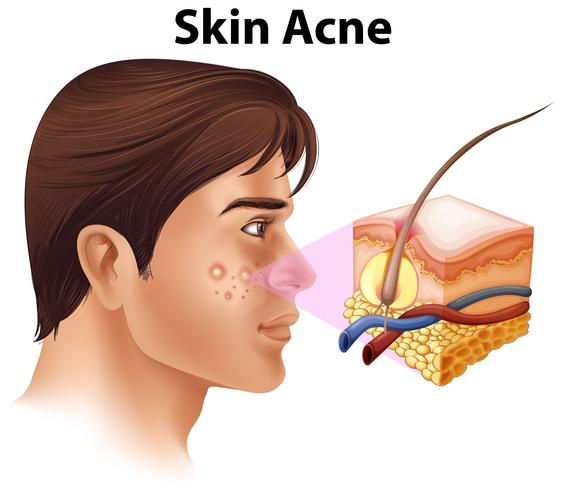 Een jonge man met acne probleem vector