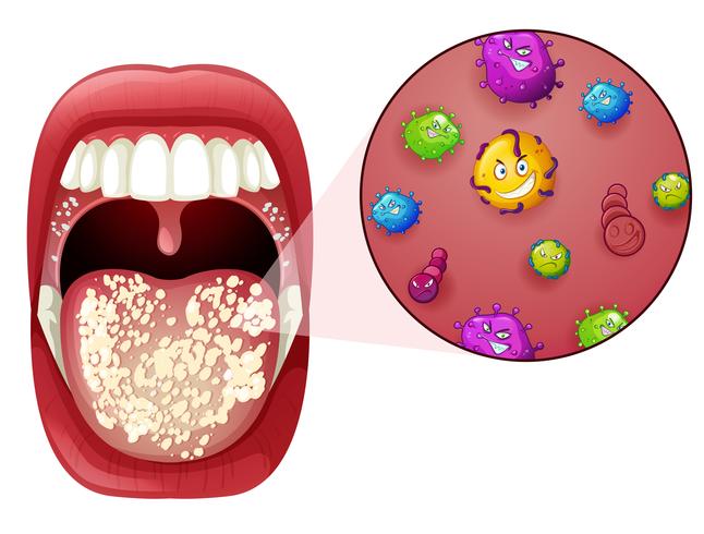 Een infectie met het menselijke mondvirus vector