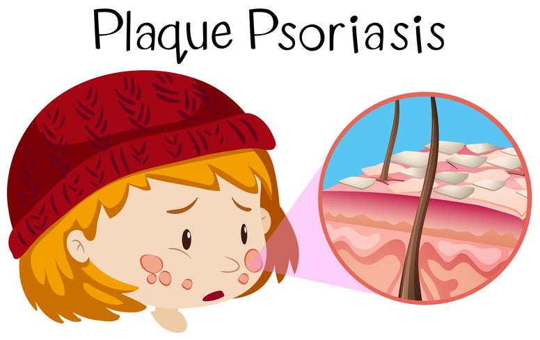 Menselijke anatomie van plaque psoriasis vector