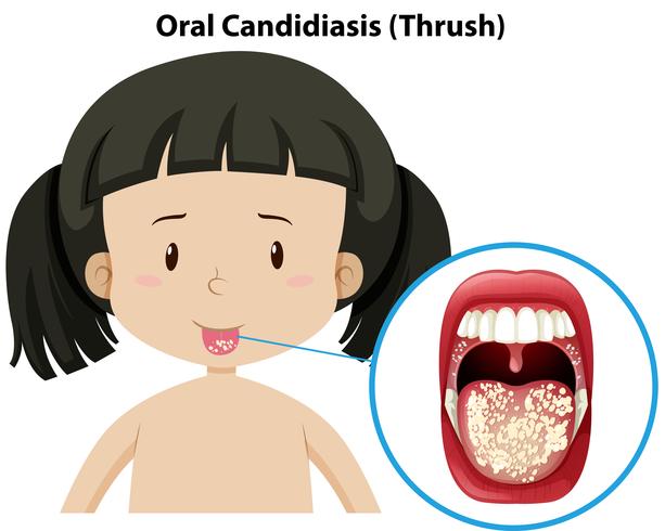 Orale Candidiasis gooit door het meisje vector