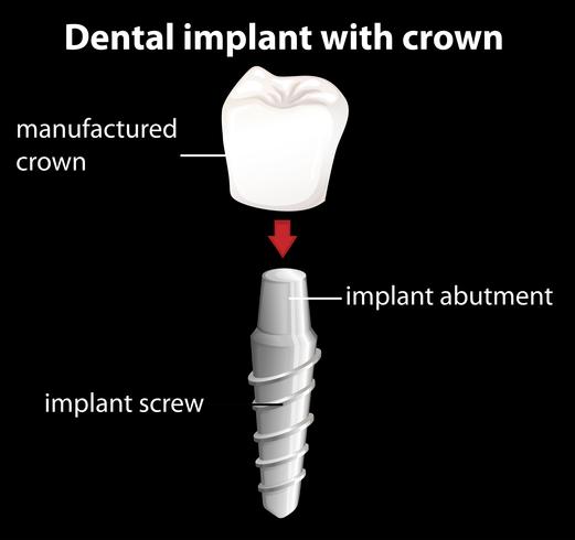 Een tandheelkundig implantaat met kroon vector