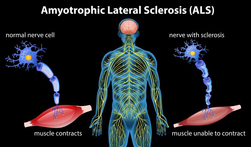 Anatomie van amyotrofische laterale sclerose vector