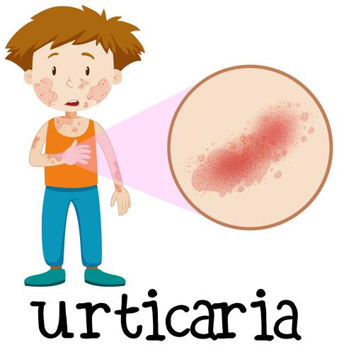 Een vector van huidurticaria