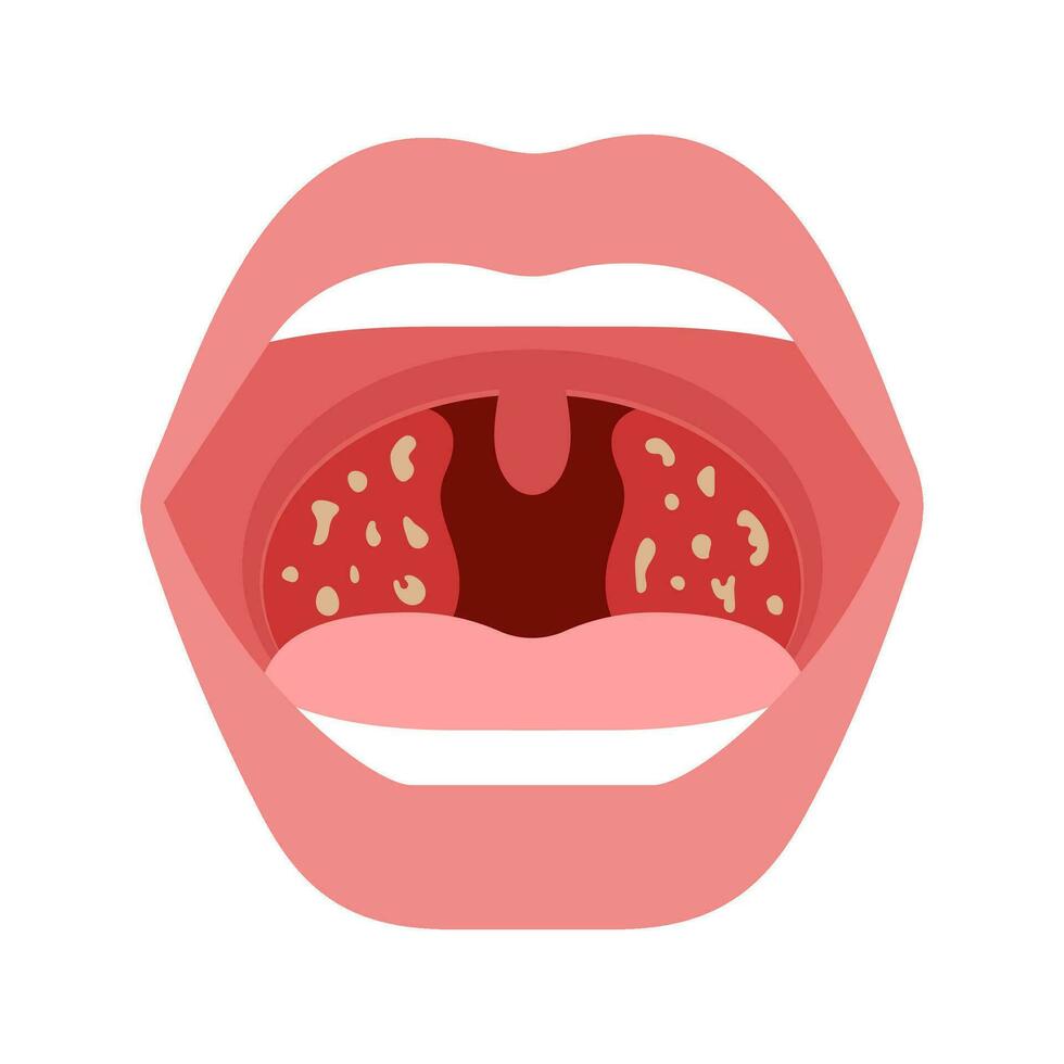 pijn in keel, tonsillitis van menselijk. Open mond met infectie stekkers, roodheid van amandelen. ontsteking luchtwegen, pijn in keel. vector illustratie