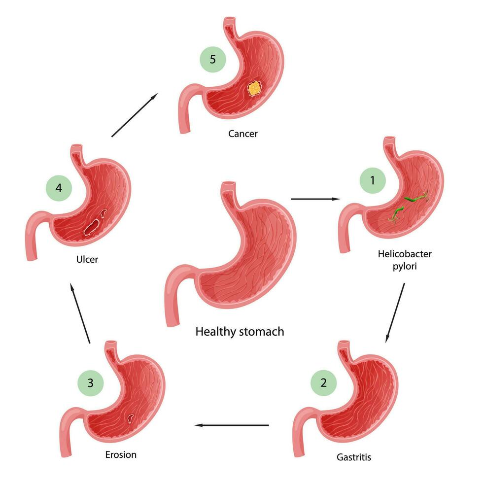 maag ziekten. diagram van ziekten van helicobacter pylori, gastritis, erosie, zweer en kanker. leerzaam anatomisch vector illustratie