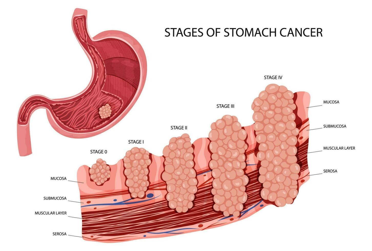 maag kanker. stadia groei kwaadaardig kankerachtig tumor. anatomisch vector illustratie geïsoleerd wit achtergrond tekenfilm stijl