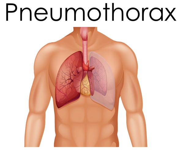 Een menselijke anatomie van pneumothorax vector