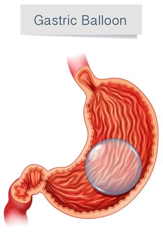 Anatomie Medische Vector Maagballon