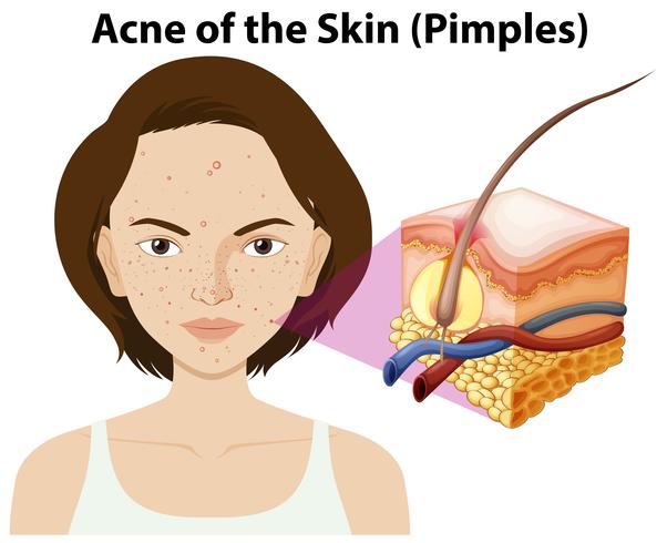 Acne van de huid van een vrouw vector