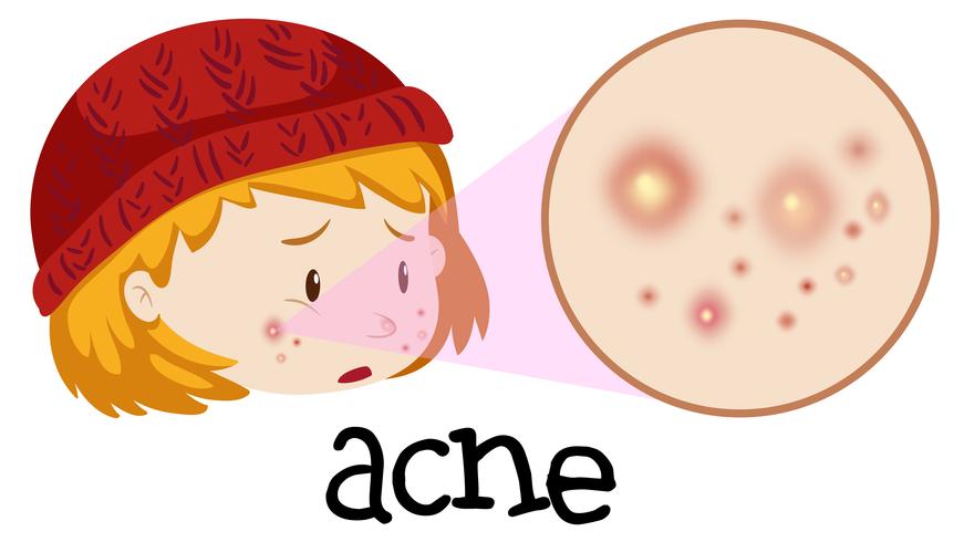 Een tiener met acne op gezicht vector