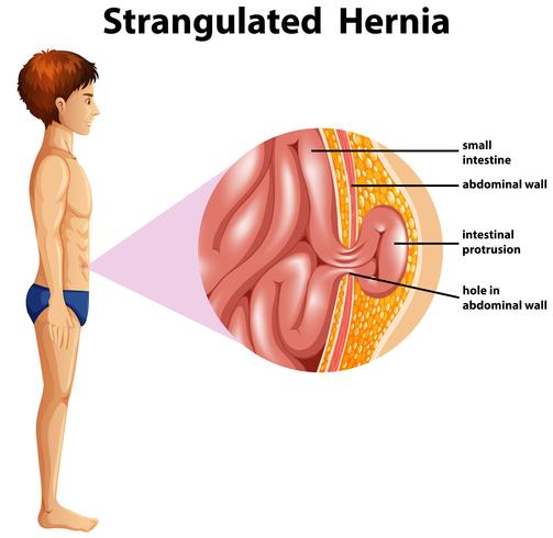 Een menselijke anatomie Gewurgde Hernia vector