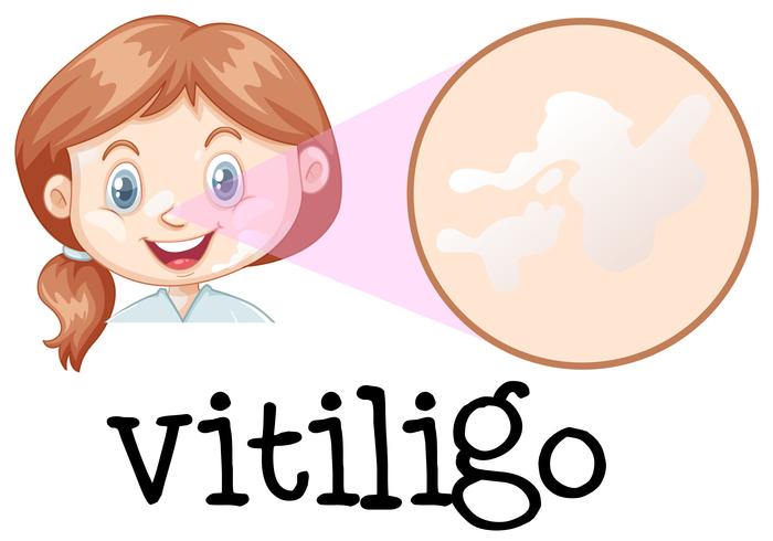 Een meisjesgezicht met Vitiligo vector