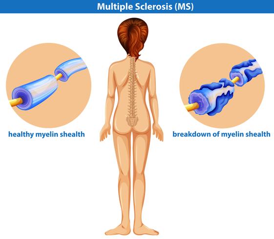 Een medische vector van multiple sclerose