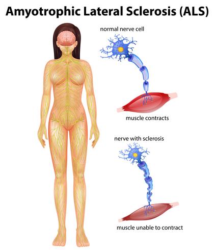 Vrouwelijke amyotrofische laterale sclerose vector
