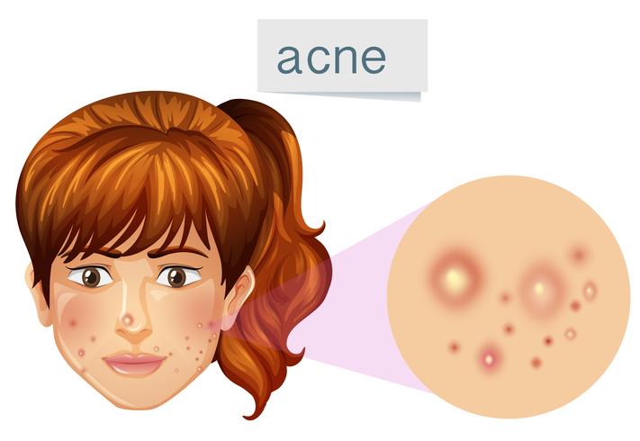 Een jonge dame acne op gezicht vector