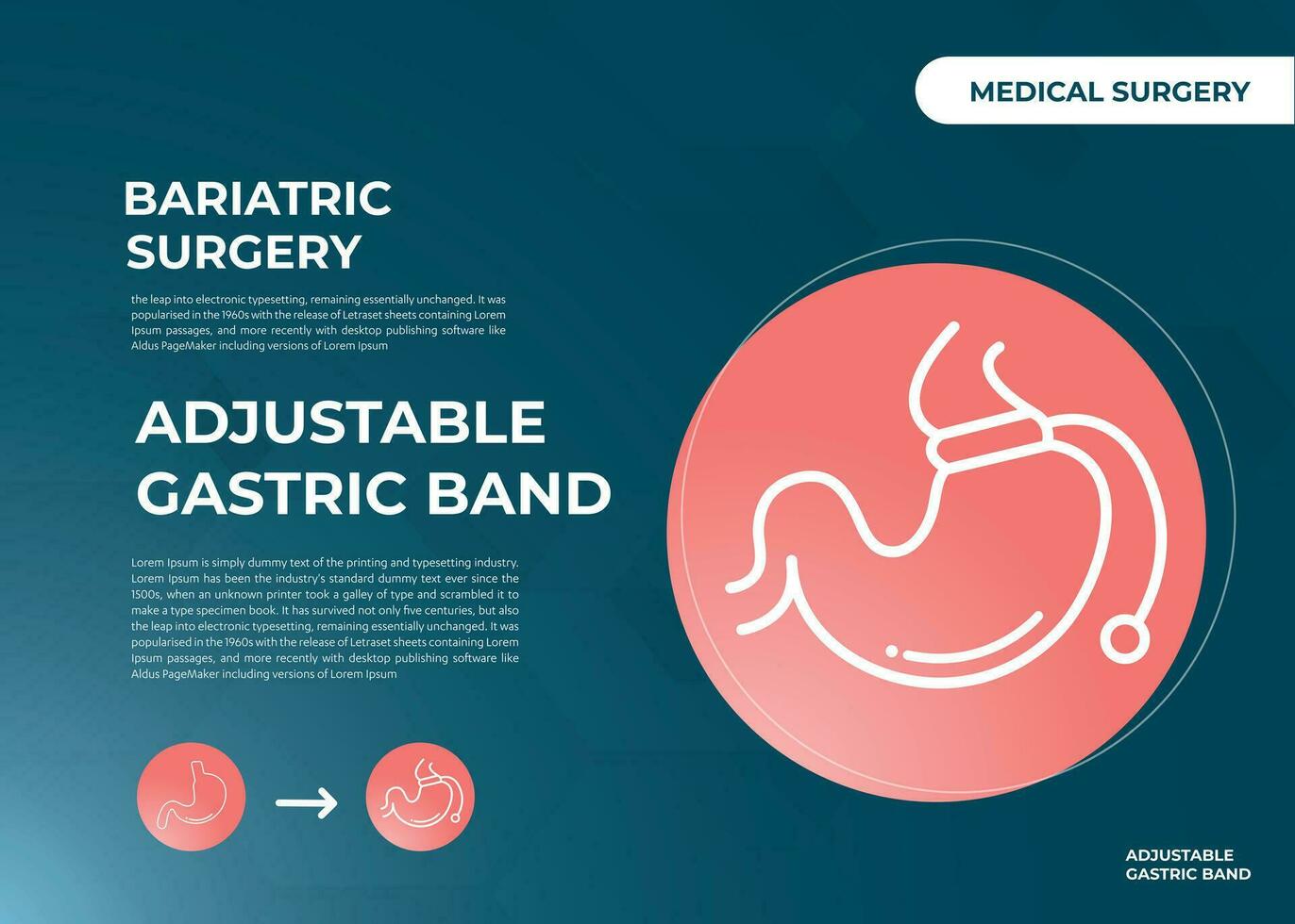 illustratie van verstelbaar maag- band bedenken gewicht verlies chirurgie vector